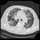 Pneumocystis carinii, HRCT: CT - Computed tomography